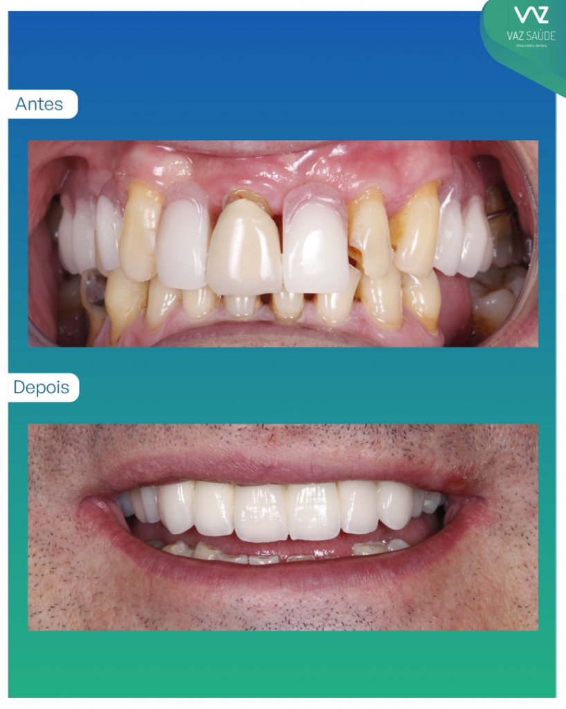 Caso antes y después