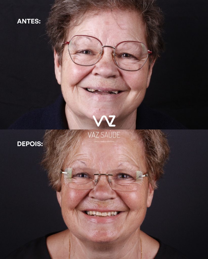 Caso Antes e Depois
