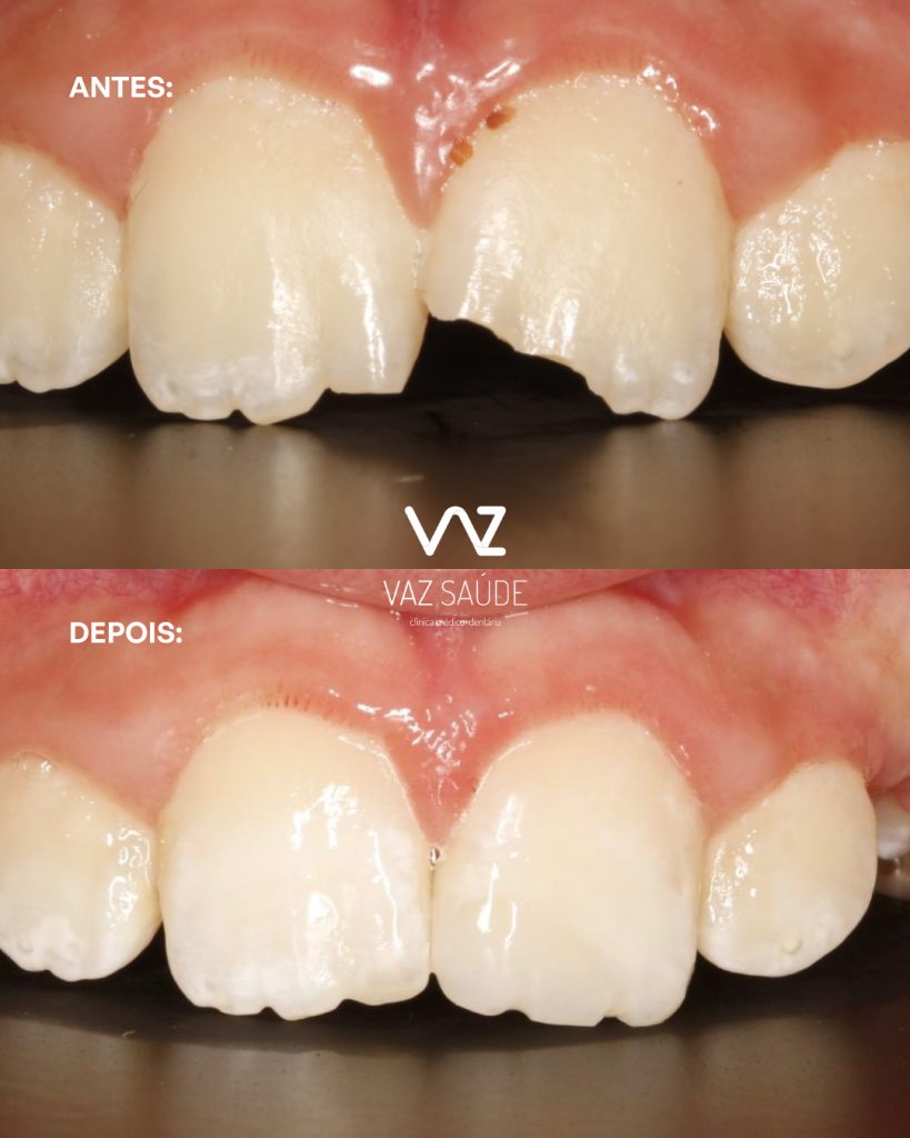 Caso Antes e Depois: Fratura de Dente