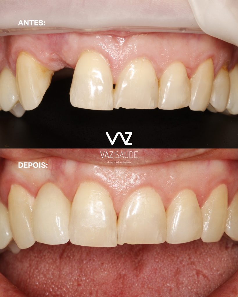 Caso Antes e Depois: Coroa Maryland