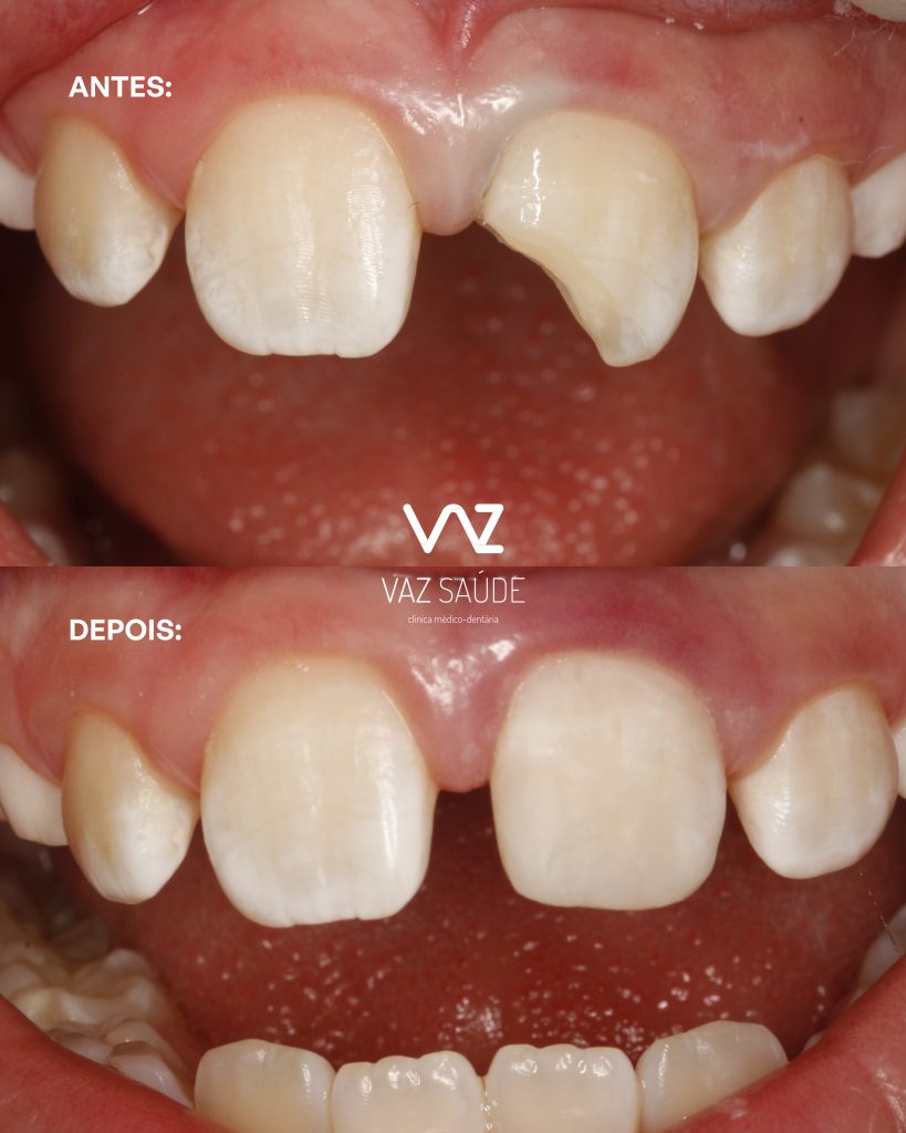 Caso Antes e Depois: Fratura